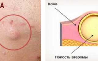 5 отличий жировика от атеромы