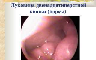 Язва луковицы двенадцатиперстной кишки