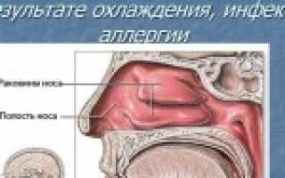 Причины и лечение атрофического ринита у взрослых