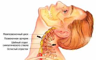 Является ли остеохондроз причиной отеков шейных позвонков