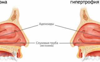 Методы удаления аденоидов у детей