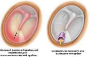 Тимпаностомия шунтирование барабанной перепонки