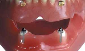 Зубные импланты: фото до и после