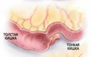 Симптомы и лечение инвагинации кишечника