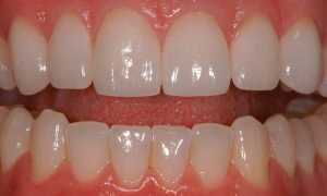 Виниры на зубы: фото до и после установки