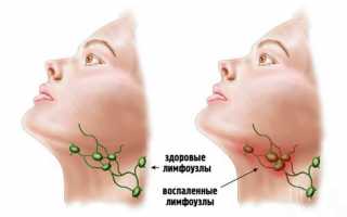 Причины увеличения лимфатических узлов на шее у взрослого
