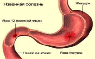 Язва 12-перстной кишки у детей