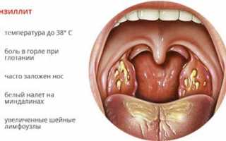 Все о лечении тонзиллита