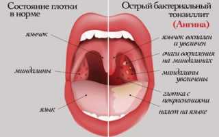 Симптомы и лечение острого тонзиллита у ребенка