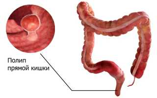 Полипы прямой кишки