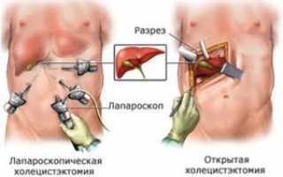 Обязательна ли операция при камнях в желчном пузыре?