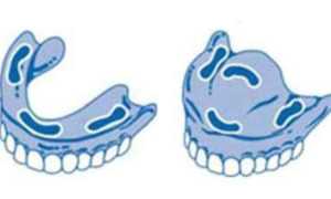 Фиксация зубных протезов при полном отсутствии зубов с помощью гелей