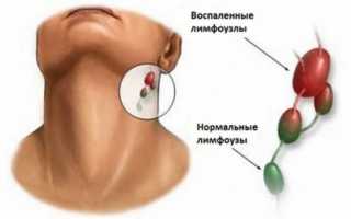 Язвы на гландах