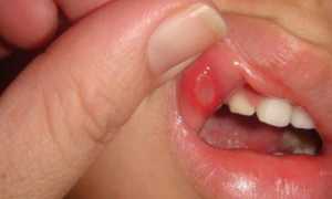 Как и чем лечить язвы во рту у ребенка