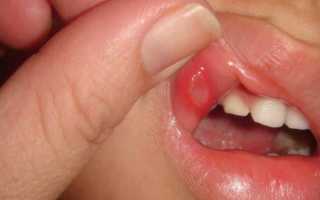 Как и чем лечить язвы во рту у ребенка