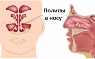 Эффективные методы лечения сильного насморка и чихания без температуры