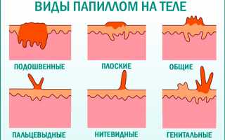 Кондиломы, папилломы, бородавка, родинка — отличие