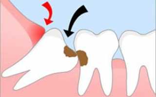 Зуб мудрости: строение, прорезывание, удаление