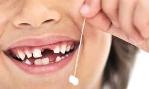 Что делать с выпавшим молочным зубом?