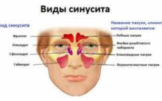 Симптомы, причины и лечение острого синусита у взрослых