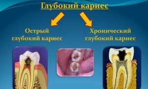 Удаление нерва из зуба