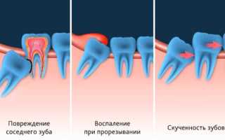 Зуб мудрости растет в бок