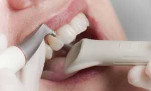 Почему зубы чернеют и что делать