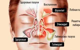 Воспаление придаточных пазух носа