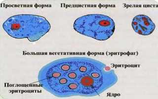 Амёбная дизентерия: что это, симптомы и лечение