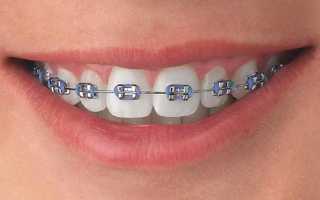 Что собой представляют брекеты American orthodontics  Mini Master