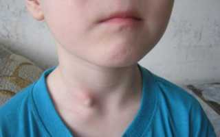 Жировик на лице, шее, спине, руке и других частях тела ребёнка. Как избавиться?