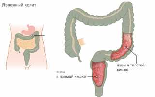 Симптомы и лечение язвы прямой кишки