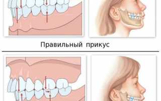 Как исправить неправильный прикус