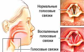 Как и чем лечить воспаление голосовых связок причины и профилактика недуга