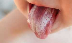 Грибок полости рта: на языке, небе, деснах