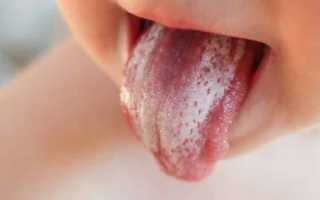 Грибок полости рта: на языке, небе, деснах