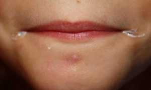 Заеды в уголках рта у беременных: причины и лечение
