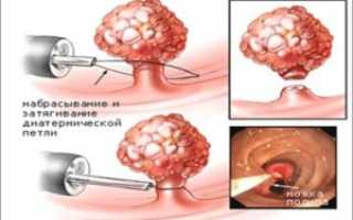 Что делать с полипами в желчном пузыре?
