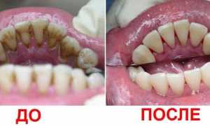 Чистка зубов ультразвуком: плюсы и минусы