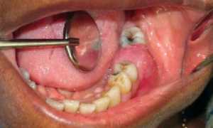 Неприятный запах изо рта после удаления зуба