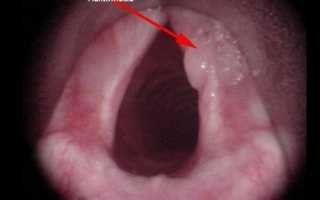 Респираторный папилломатоз гортани у детей