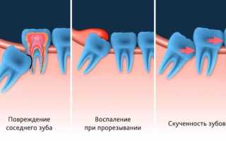 Рекомендации после удаления зуба мудрости