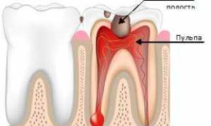 Пульпит зуба: симптомы, лечение, профилактика