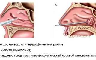 Что такое конхотомия носовых раковин