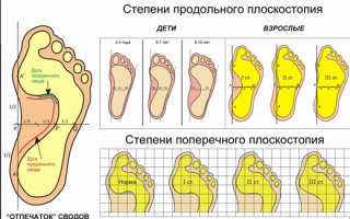 Какие есть виды и формы плоскостопия, их диагностика и определение