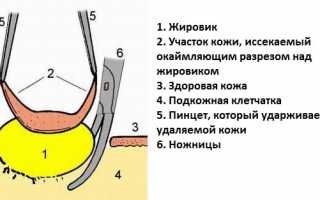 Причины появления жировика за ухом