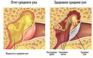 Острый средний отит лечение