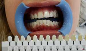 Вредно ли отбеливать зубы