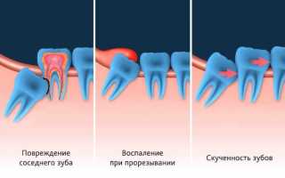 Как выглядит зуб мудрости: фото восьмерки