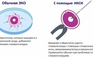 ИМСИ и ИКСИ: в чем заключаются данные методы оплодотворения